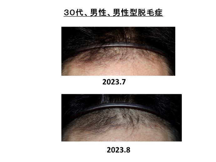 円形脱毛症　病院